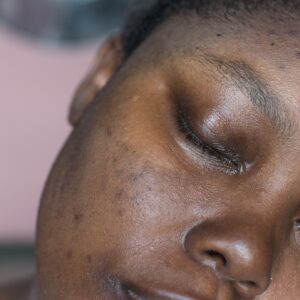 Module 03 of 3 – Level 2 Awareness in Skin of Colour (Melanin-Rich Skin) for Aesthetic Practitioners